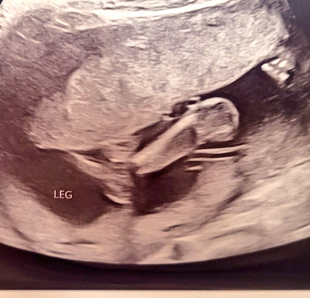 pasteldotz's tweet photo. Anatomy ultrasound! Baby just knew we needed a good look at it today and stayed curled up the whole time lol. Literally had to shake my belly to get some shifting, but we got some cool shots! 👣 https://t.co/6guKPWzSbd