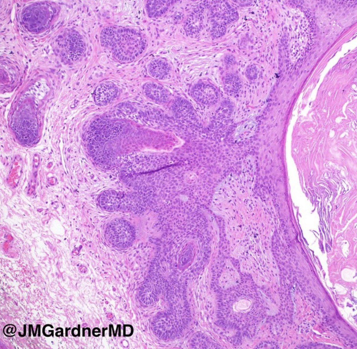 A #dermpath classic! Your diagnosis? Click here for answer: kikoxp.com/posts/8476. #pathology #pathologists #pathTwitter #dermatology #dermatologia #dermtwitter