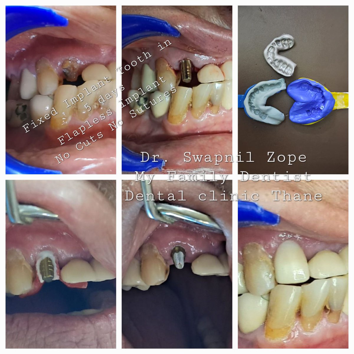 drswapnilz's tweet image. TIME TO SAY CHEESE
78YR YOUNG Diabetic person with desire to Enjoy Food and Look Good-  receives Implant Supported Fixed Tooth on 5th Day after implant placement. #Betterteethbetterhealth #Teethin3to5days #FixedTeeth # Dentist in Thane #Dentistrymypassion #PediatrictoGeriatricDen