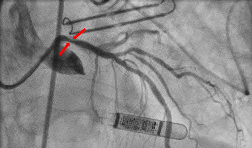 DJ Lakkireddy (@dj_lakkireddy) on Twitter photo Guess what’s happening here - pt presents with recurrent angina. It’s rare but can happen. 4 the rest of the story read. authors.elsevier.com/a/1hj016uPJvqh… <a href="/JACCJournals/">JACC Journals</a> <a href="/Adnan_AhmedMD/">Adnan Ahmed</a> <a href="/Danishbawa3/">Danish Bawa</a> <a href="/KcHeartrhythm/">KCHRI</a> <a href="/AtriCure/">AtriCure, Inc.</a> <a href="/IslaaFoundation/">ISLAA</a> <a href="/SCAI/">SCAI</a> <a href="/ACCinTouch/">American College of Cardiology</a> Guess what’s happening here - pt presents with recurrent angina. It’s rare but can happen. 4 the rest of the story read. authors.elsevier.com/a/1hj016uPJvqh… <a href="/JACCJournals/">JACC Journals</a> <a href="/Adnan_AhmedMD/">Adnan Ahmed</a> <a href="/Danishbawa3/">Danish Bawa</a> <a href="/KcHeartrhythm/">KCHRI</a> <a href="/AtriCure/">AtriCure, Inc.</a> <a href="/IslaaFoundation/">ISLAA</a> <a href="/SCAI/">SCAI</a> <a href="/ACCinTouch/">American College of Cardiology</a>