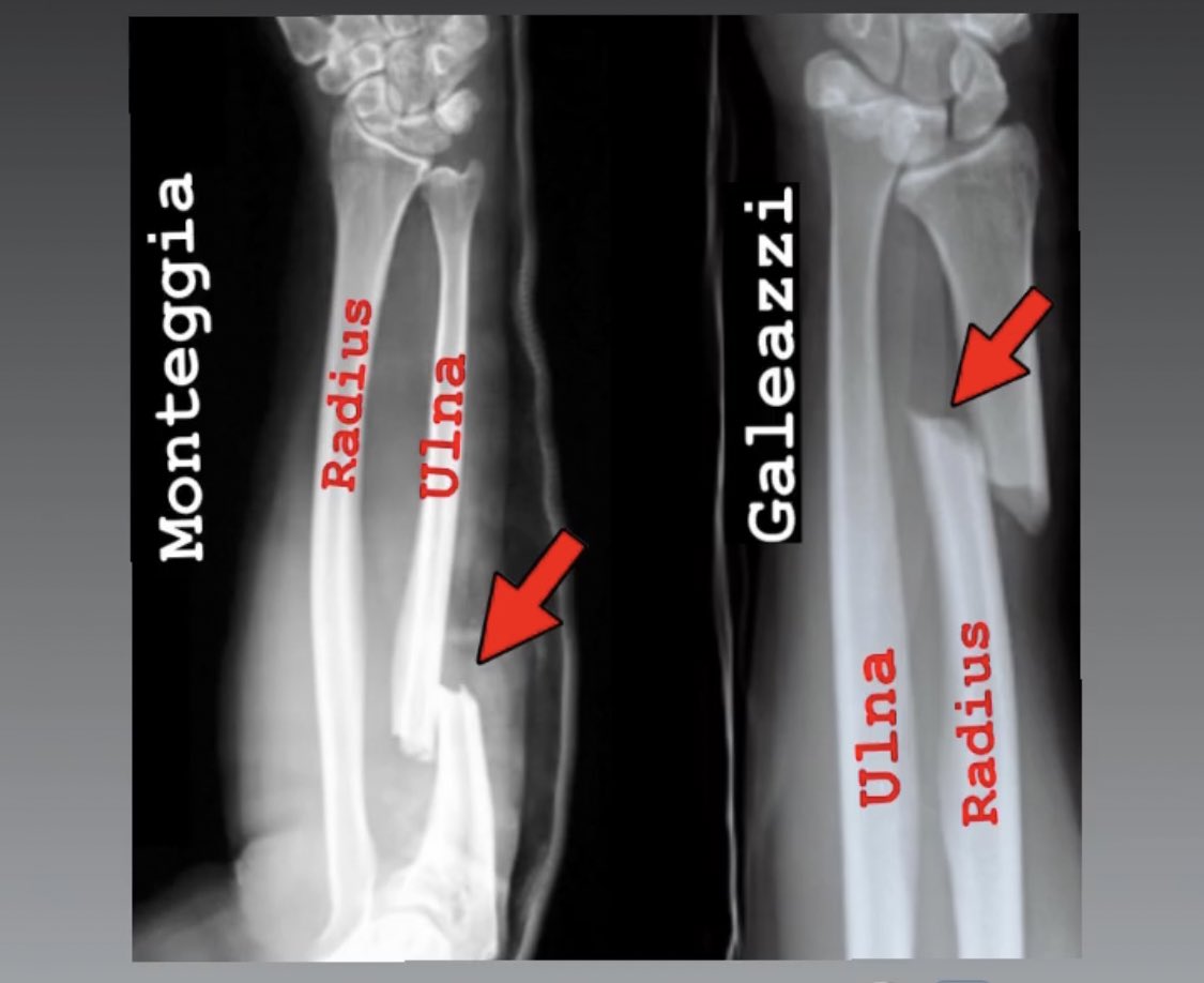- Fractures that occurs in forearm

- Monteggia fracture: fracture of proximal ulna with dislocation of radial head 

- Galeazzi fracture: fracture of distal 1/3 of radius with disruption of distal radioulnar joint

#علاج_طبيعي