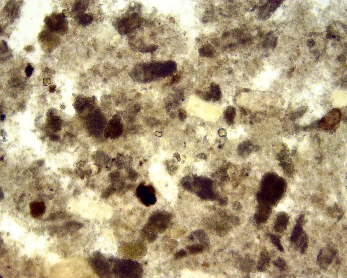 1/n context: obstructive ureteral stone, UTI, pyonephrosis on ureteroscopy, hypotension, AKI. 99% ischemic ATN from septic shock. Fair enough. #UrineMicroscooy still done as routine diagnostics. At glance, looks like tons of muddy brown granular casts, anchoring our impression