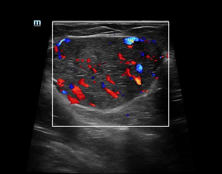 MindrayGlobal's tweet image. Our latest case study highlights how a multiparametric approach has helped exclude neovascularization detected by Dopplerography, confirmed by morphological results. Link to the full case: mindray.com/en/media-cente…
#ULtrasoundJournal #Multiparametric #BreastCancerAwareness