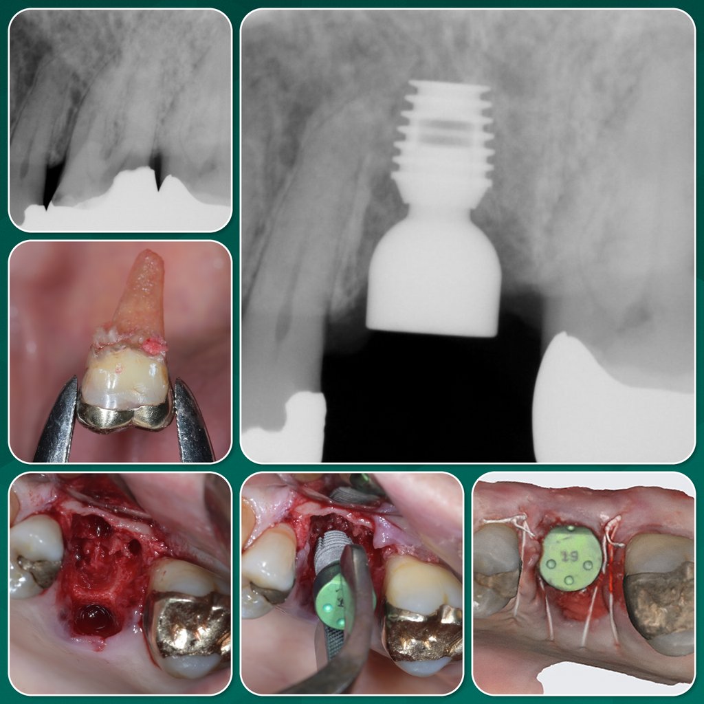 bicon's tweet photo. 📷 NEW CASE! Extraction of a molar, atraumatic removal of the distobuccal and mesiobuccal roots, and immediate placement of a 5.0 x 6.0mm SHORT® Implant. Link: https://t.co/NOrTcFxGhA #bicon #onlybicon #shortimplants #dentalimplants #biconisasolution #digitaldentistry #cadcam https://t.co/XgrNVU8r0p