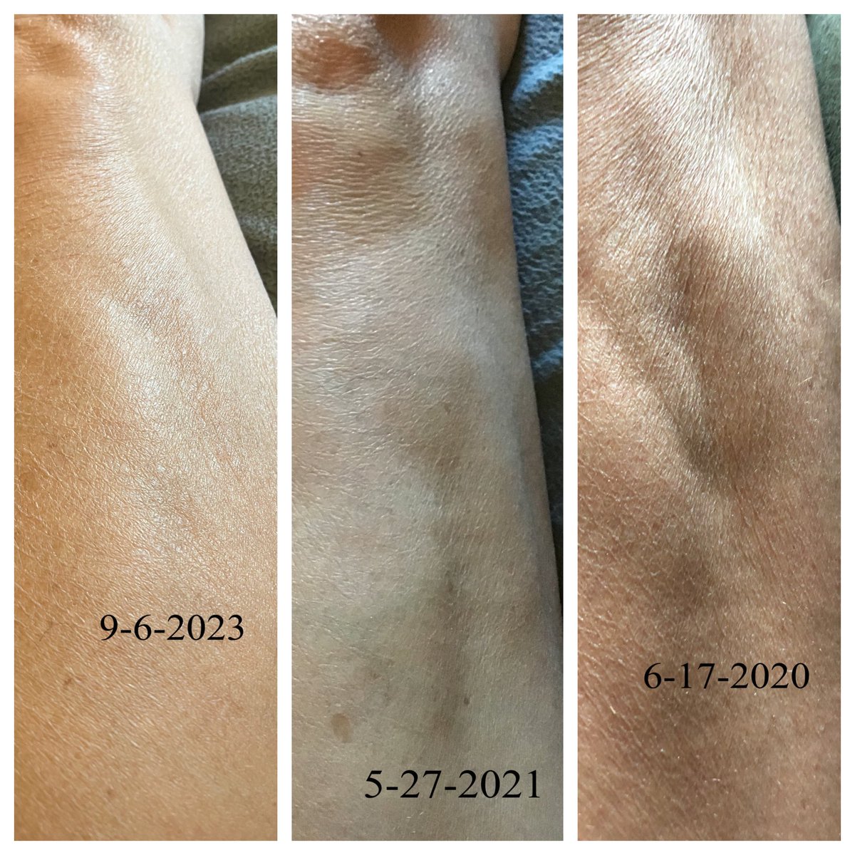 Chalenging_MS's tweet photo. 🤔 it’s an amazing coincidence that since I started addressing the connective tissue in 2020 the restrictions in my quadricep muscle, not only feels less but appear less visually.  I’m excited for the day they find a way to image the connective tissue! @Taopatch https://t.co/eqDvbwqYzl