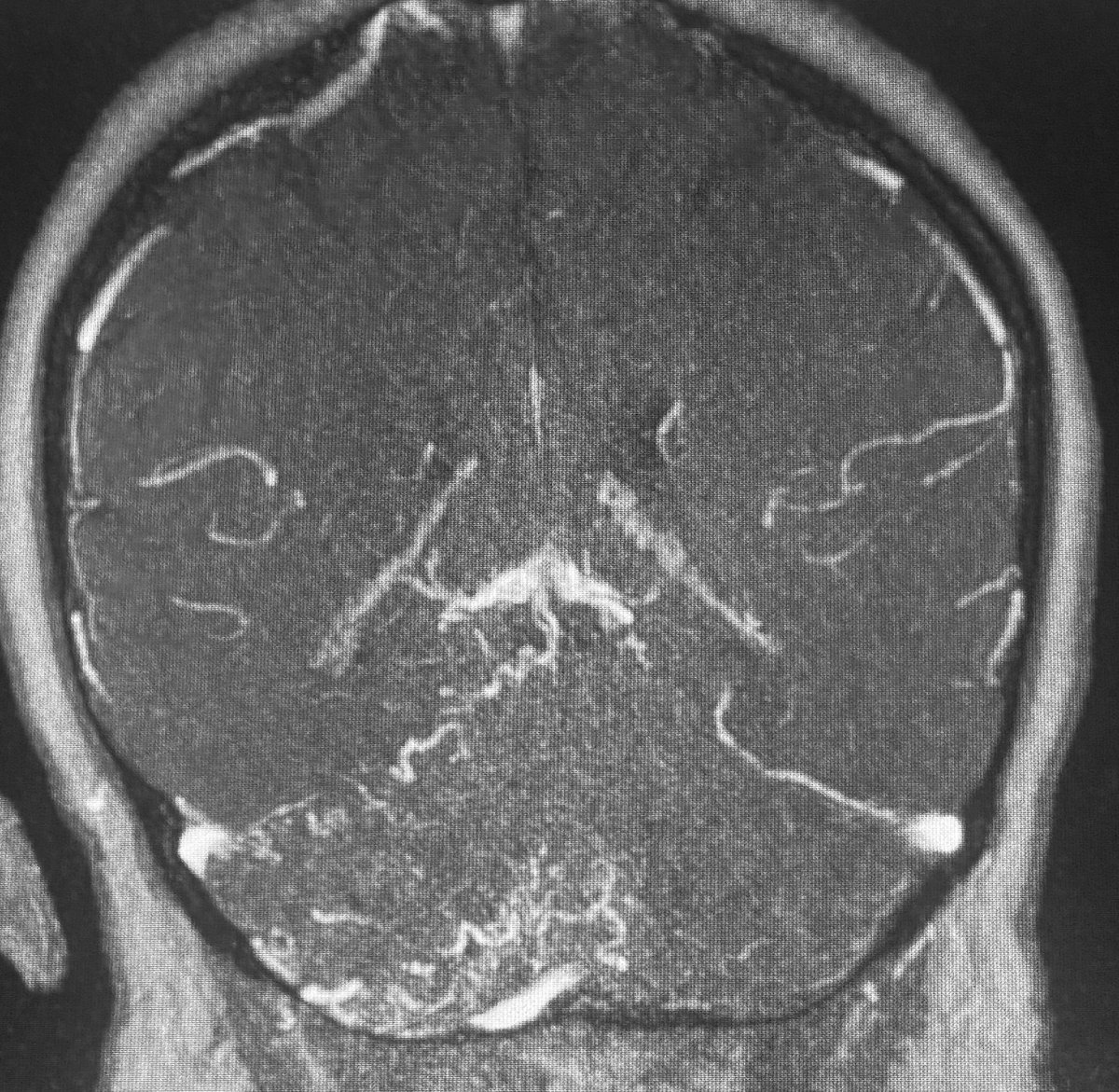 STateshimaMD's tweet image. Negative MRA per report but increased vascularity in Rt cerebellum suggestive of venous congestion. Stat DSA showed a small tentorial dural AVF with cortical venous reflux and small varix, a high risk for bleeding.