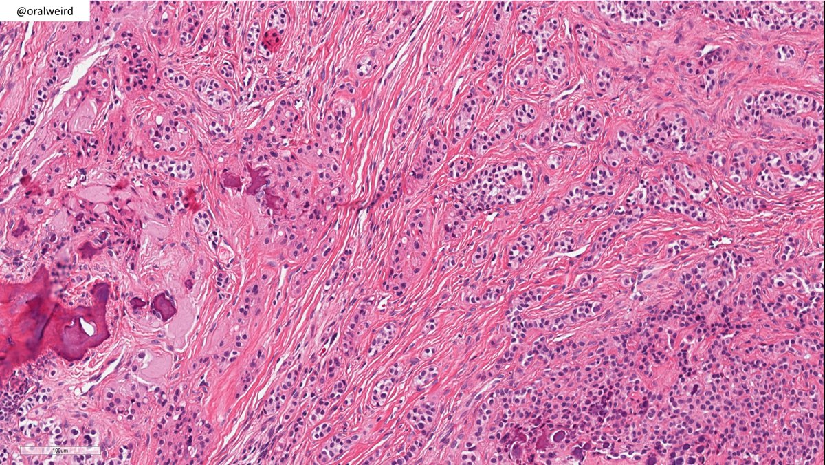 One 📸▶️👆diagnosis for this mandibular lesion! #pathology #pathologist #headandneck #PathTwitter #picoftheday #oralpath #ENT #ENT_Pathology #headandneckpathology #Pediatric