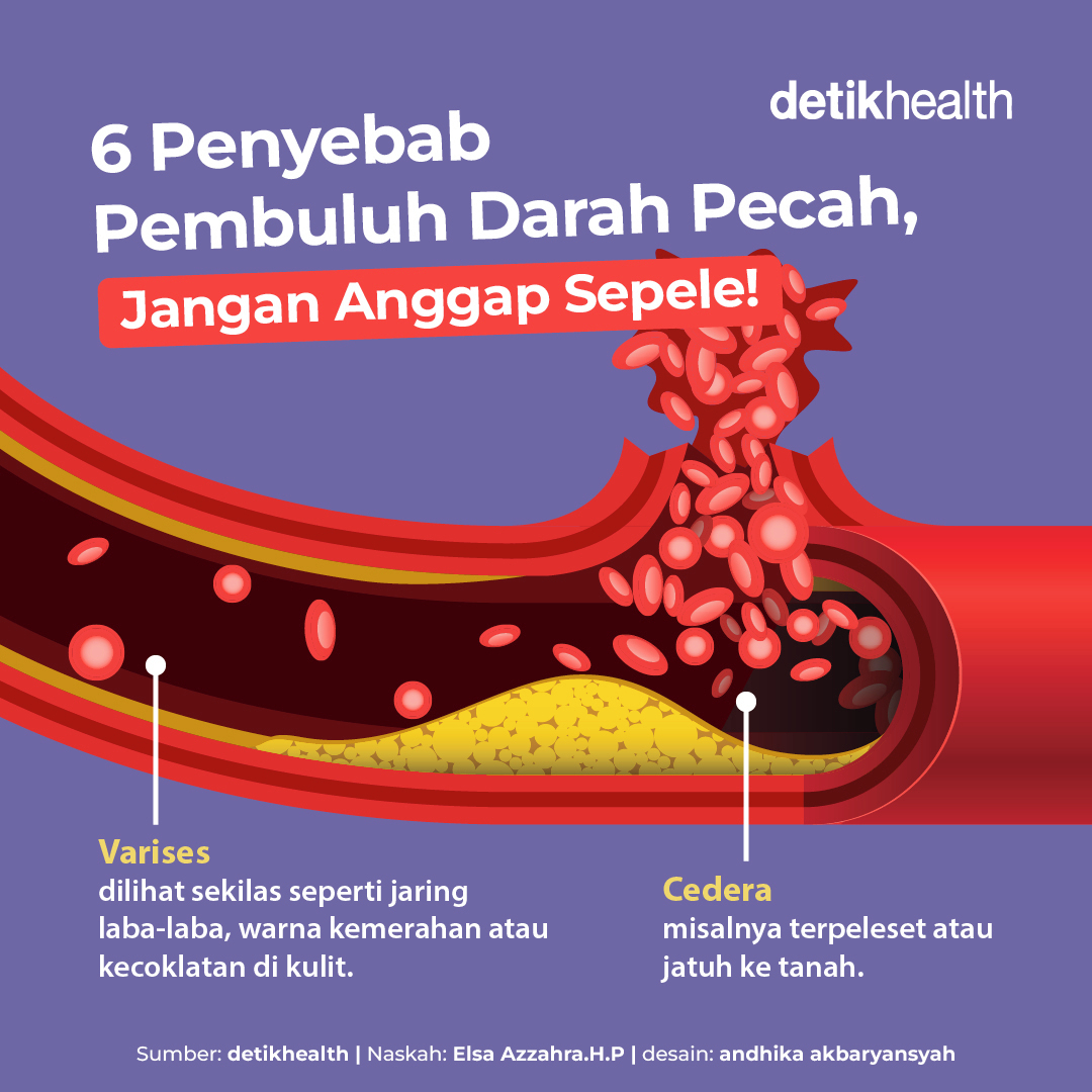 detikHealth's tweet photo. detikers tahu nggak sih, dalam kondisi tertentu pembuluh darah manusia bisa pecah lho😨
Lantas, apa yang menyebabkan pembuluh darah pecah ya? Yuk Simak pembahasannya secara lengkap di gambar berikut.
#pembuluhdarah #pembuluhdarahpecah #varises #hipertensi #detikhealth https://t.co/d4T0mXdlvg