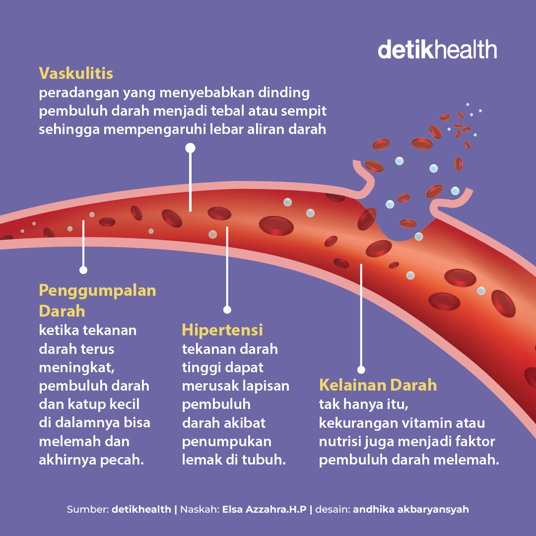 detikHealth's tweet photo. detikers tahu nggak sih, dalam kondisi tertentu pembuluh darah manusia bisa pecah lho😨
Lantas, apa yang menyebabkan pembuluh darah pecah ya? Yuk Simak pembahasannya secara lengkap di gambar berikut.
#pembuluhdarah #pembuluhdarahpecah #varises #hipertensi #detikhealth https://t.co/d4T0mXdlvg