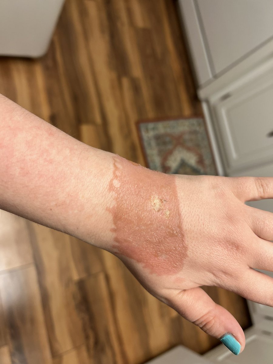 itsmojo_jojo's tweet photo. I tipped a candle toward myself to blow it out; the wax spilled and the flame flared 😅 tis mostly a third degree burn https://t.co/3Ks6x3gAuI