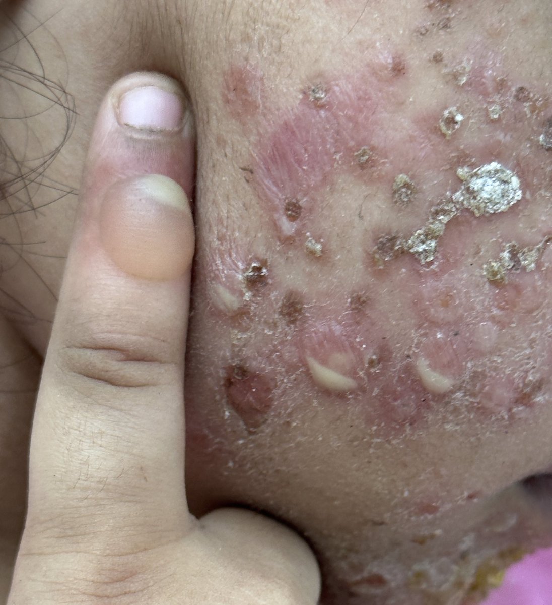 docpiyush's tweet photo. Classic textbook picture
#MedEd
#MedTwitter
#dermtwitter
#dermatology
#PedDerm https://t.co/s53Lej78yA