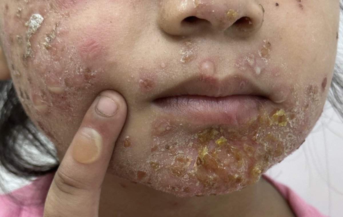 docpiyush's tweet photo. Classic textbook picture
#MedEd
#MedTwitter
#dermtwitter
#dermatology
#PedDerm https://t.co/s53Lej78yA