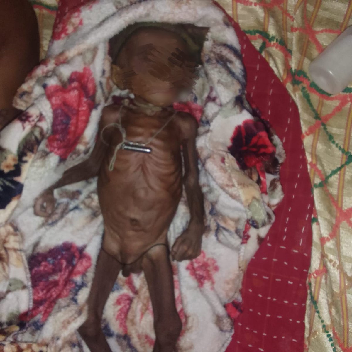 Duruputa Kalar(2mths) F-Krishna Kalar,Nuaguda AWC,BorigamGP, Dabugaon,ngpur.Due to vomiting he admitted UmerkoteCHCon23/07and refer to Koraput,without cure he  was discharged.Then family take him CGand rtrn inSAMon5/08pls intervene soon. <a href="/CMO_Odisha/">CMO Odisha</a>,<a href="/DMnabarangpur/">Collectorate Nabarangpur</a>, <a href="/OrissaRtf/">Right to Food Campaign, Odisha</a>.