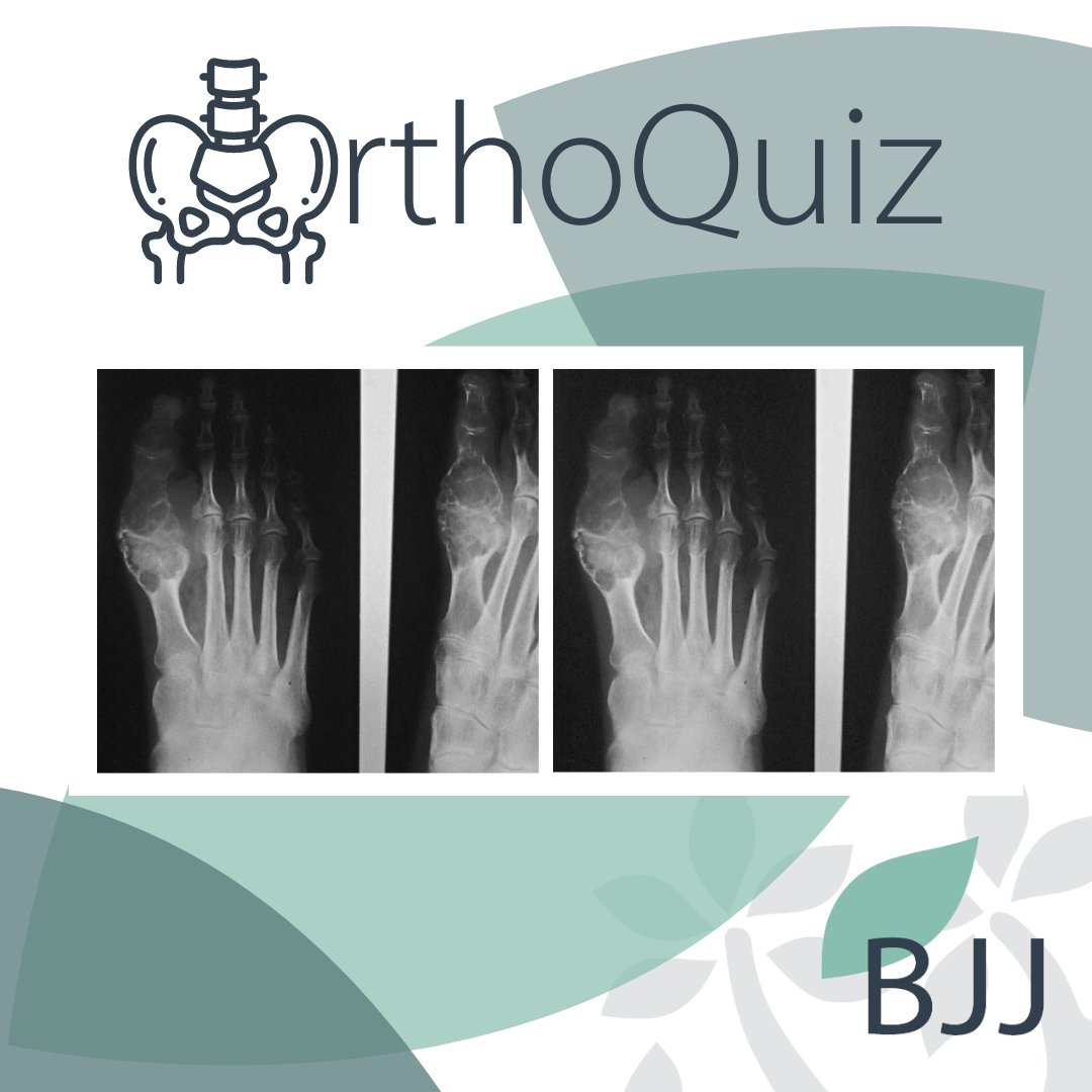 BoneJointJ's tweet image. ✨ ORTHOQUIZ 🦶

Take a look at these anteroposterior and oblique radiographs centred on the first ray of the right foot.

What is your diagnosis?

#OrthoQuiz #Radiograph #Surgeons #MedEd