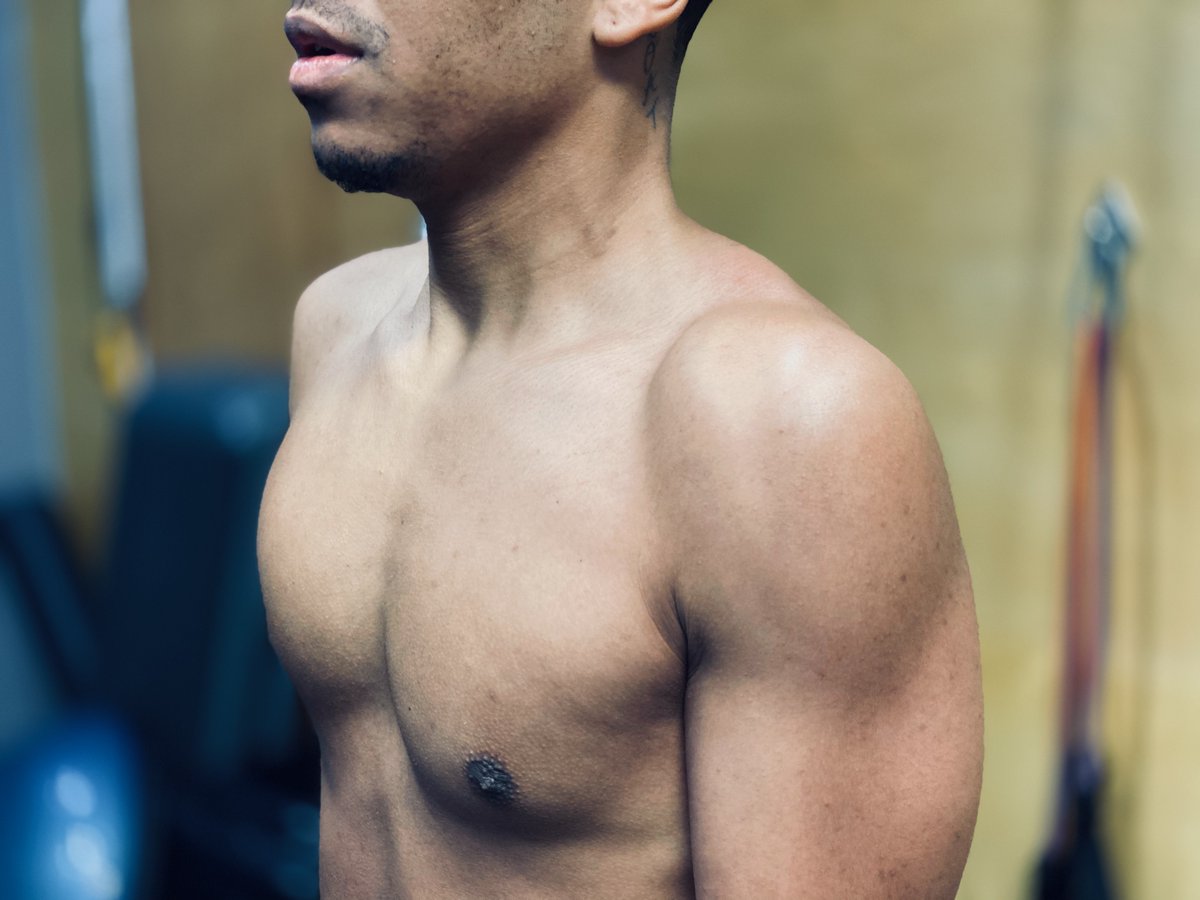 CityPT_Inc's tweet photo. Before an effective treatment program can be prescribed for shoulder pain, determining the underlying cause of pain is vital. A physical therapist can do this. A couple of common causes of pain: 1. Shoulder shape. 2. How your shoulder blade moves. 3. Posture. https://t.co/EJuxIINYe7