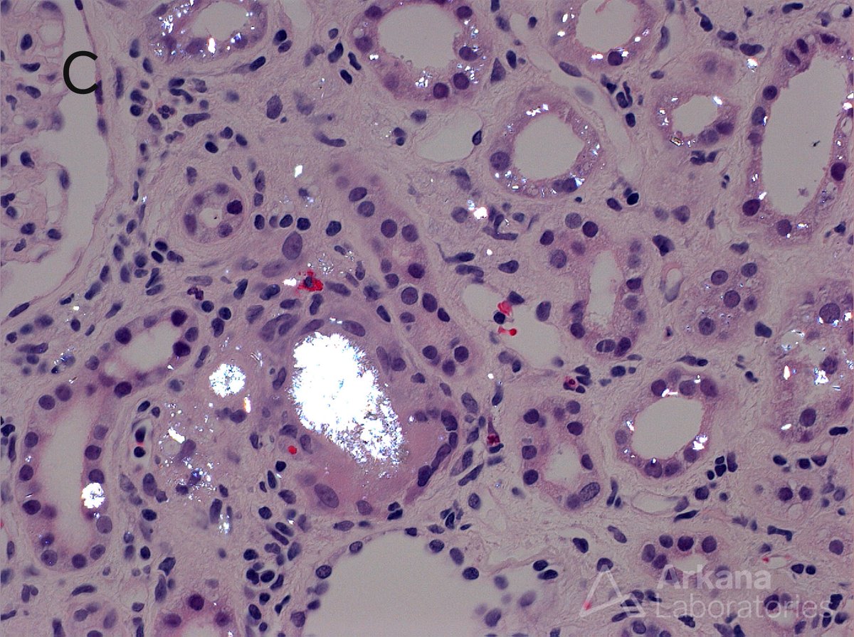 arkanalabs's tweet photo. Today's #TeachingPoint comes from our Executive Director, Dr. Chris Larsen!
The renal biopsy shown here has crystals present within the tubular lumens and cytoplasm with a brownish appearance by H&E (A) that are strongly silver positive on the Jones methenamine silver stain (B). The crystals are birefringent when viewed under polarized light (C). These findings are characteristic of 2,8 DHA crystal deposition in the kidney resulting from a deficiency of adenine phosphoribosyltransferase. 2,8 dihydroxyadeninuria is an autosomal recessive disease resulting from pathogenic variants in the APRT gene. It is an important disease to recognize as treatment with a low purine diet and allopurinol therapy blocks formation of 2,8 DHA and can improve renal function. The differential diagnosis includes other crystalline nephropathies. One that is less well known but has a similar histopathology is triamterene crystalline nephropathy, which can be distinguished from 2,8 DHA by the presence of “Maltese crosses” under polarized light.
#RenalPath