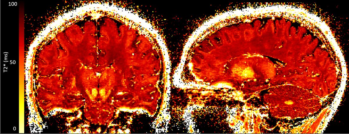 Tom Hilbert (@tomhilbertmri) on Twitter photo We are looking for two PhD students to join our team in Lausanne right at lake Geneva, working on deep learning topics around ultra-high-field magnetic resonance imaging. Please apply and re-tweet (re-X)!
<a href="/acit_research/">Advanced Clinical Imaging Technology - ACIT</a> <a href="/SiemensHealth/">Siemens Healthineers</a> #MRI #PhDposition
jobs.siemens-healthineers.com/careers/job?jo… We are looking for two PhD students to join our team in Lausanne right at lake Geneva, working on deep learning topics around ultra-high-field magnetic resonance imaging. Please apply and re-tweet (re-X)!
<a href="/acit_research/">Advanced Clinical Imaging Technology - ACIT</a> <a href="/SiemensHealth/">Siemens Healthineers</a> #MRI #PhDposition
jobs.siemens-healthineers.com/careers/job?jo…