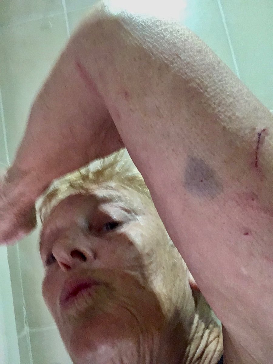 HigherInsight1's tweet image. #Triangularmark
#mediumsize 
The cuts are from falling with my tricycle into the rose bushes in the park 
I often get these shaped #trianglemarks on my arms legs and torso
