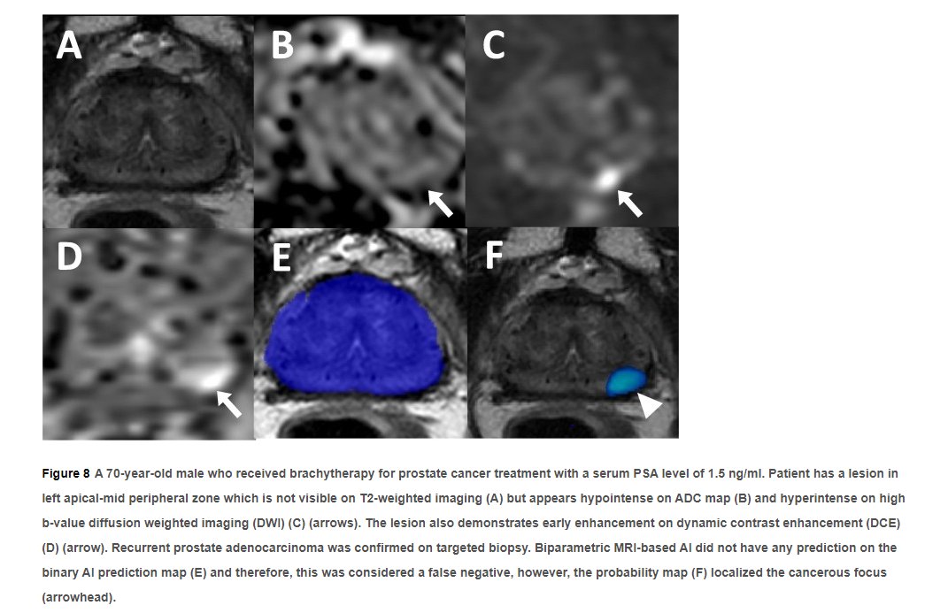 radiolobt's tweet photo. 📣I am happy to share our new article "Evaluation of a Deep Learning-based Algorithm for Post-Radiotherapy #ProstateCancer Local Recurrence Detection Using Biparametric MRI" https://t.co/iBHJFeArGo
🔵Congratulations to @eniscy and our Team for this nice work
#CancerResearch #MedTwitter #TeamScience