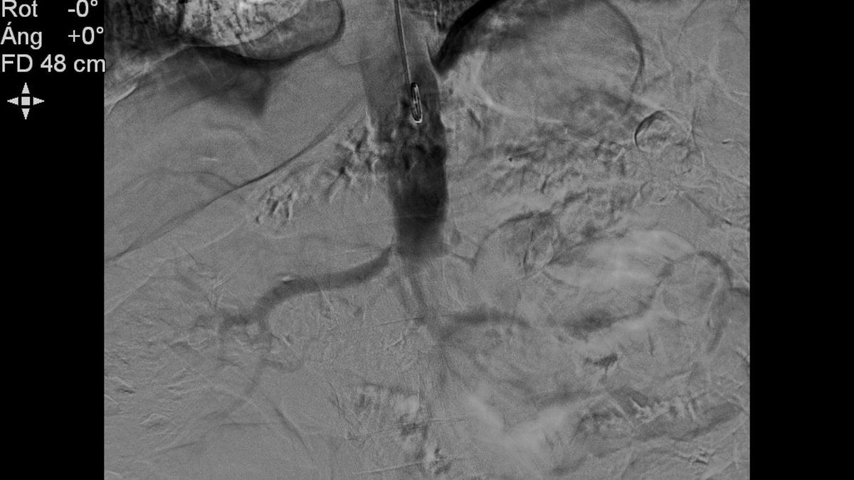 RVIchuac's tweet photo. Fumador. DL. Obesidad. DM2. Enf. de Buerger.
ERC agudizada.
HTA mal controlada (TAS de hasta 170) a tto con más de 3 fármacos.

Aortografía: sdme de Leriche, estenosis arteria renal derecha y oclusión de la arteria renal izquierda. https://t.co/lc5ktrYxvi