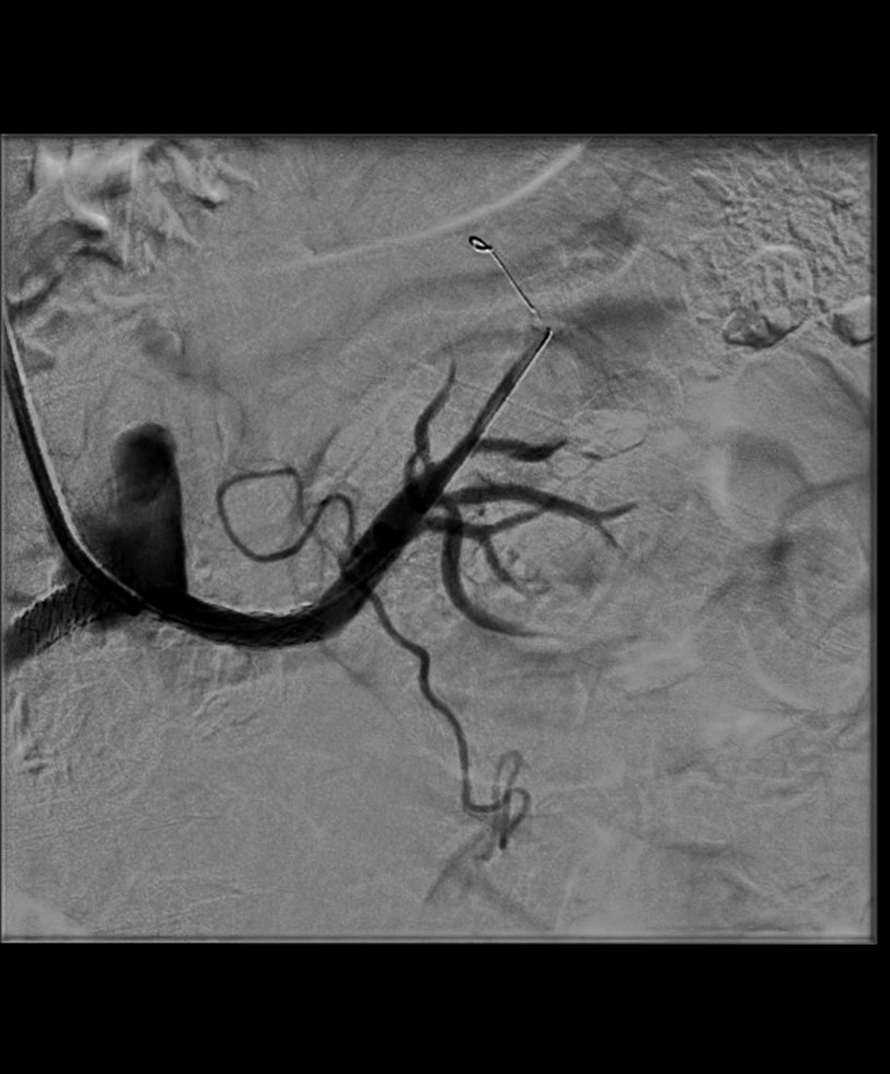 RVIchuac's tweet photo. Se trató al paciente realizando angioplastia de ambas arterias renales y colocando un stent en cada arteria. https://t.co/CBYAsGw1VS