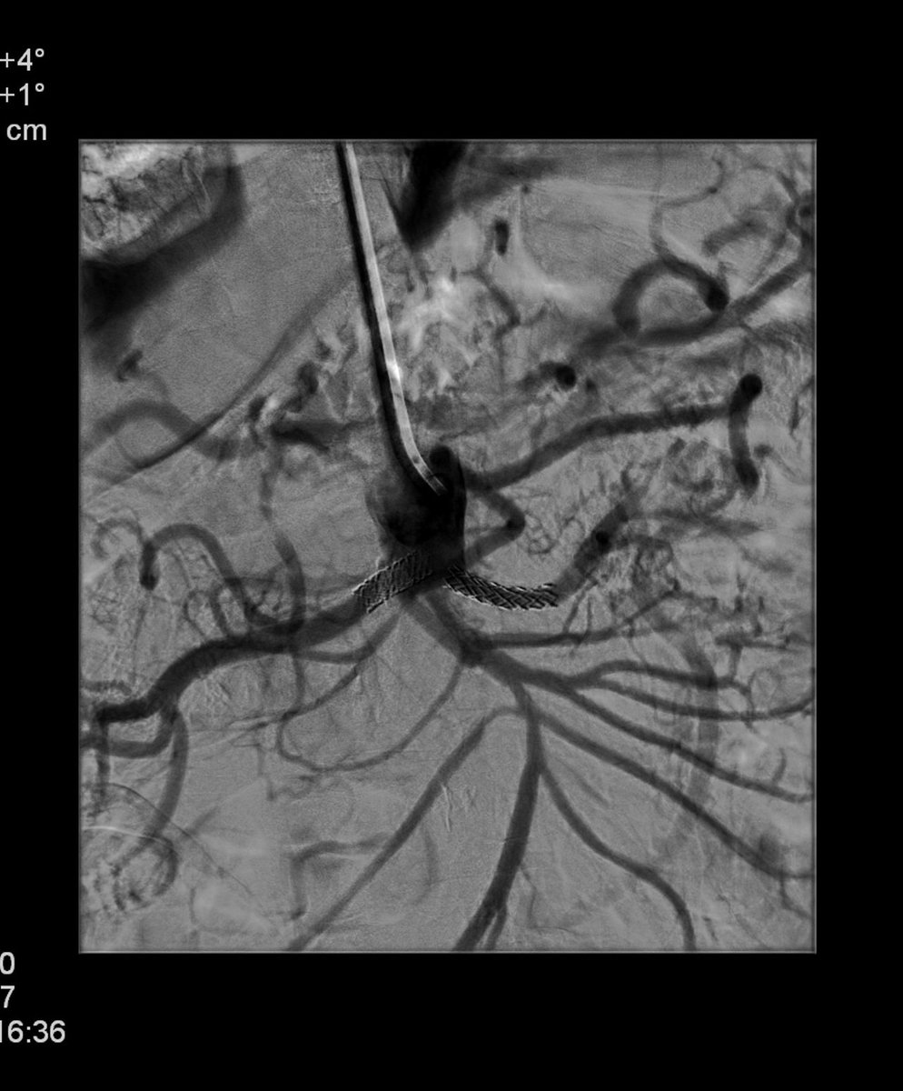 RVIchuac's tweet photo. Se trató al paciente realizando angioplastia de ambas arterias renales y colocando un stent en cada arteria. https://t.co/CBYAsGw1VS