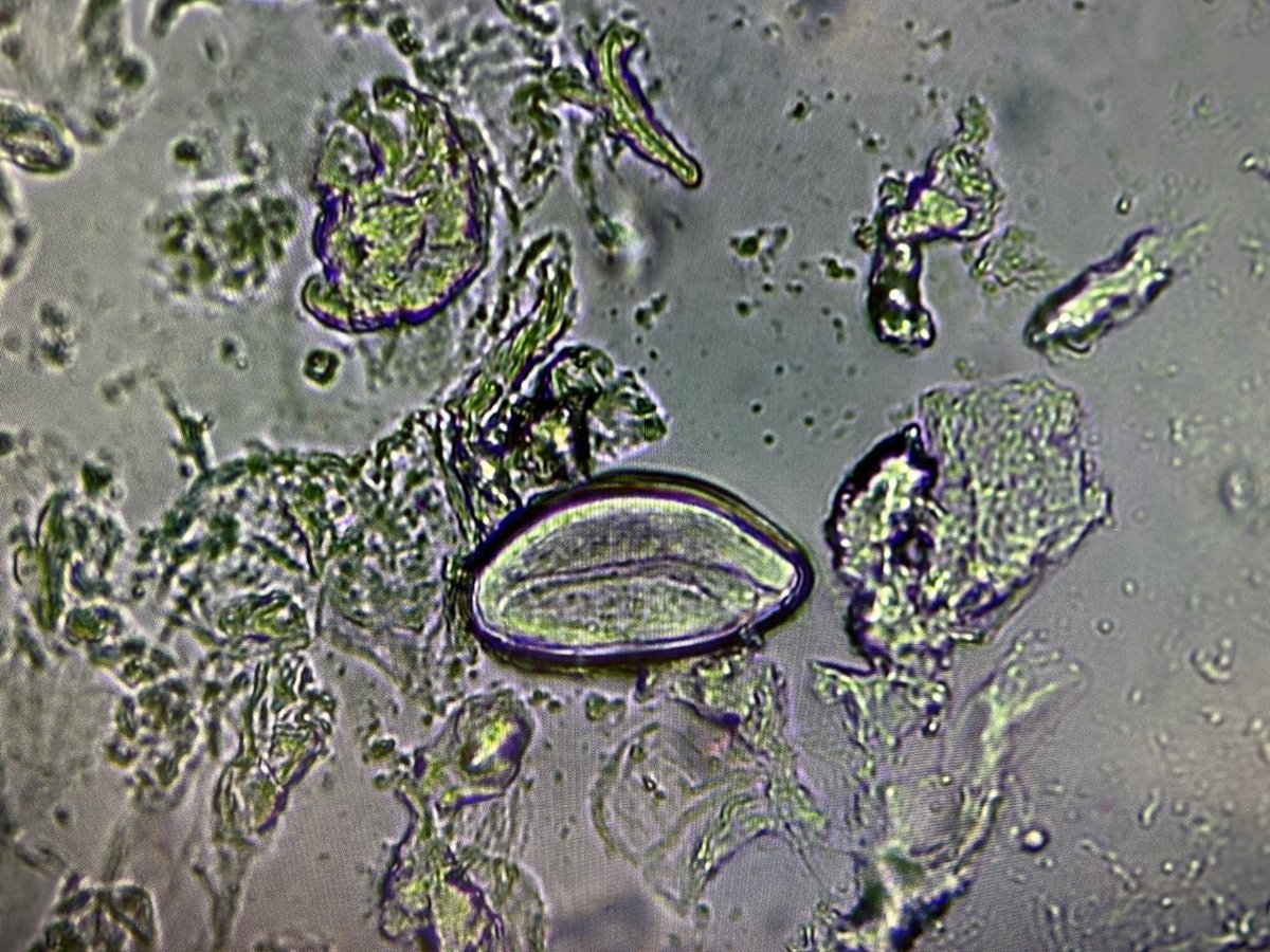 MicrobioHUPA's tweet photo. ☣️🪱🥚👶👧🏻👦🏼
Os mostramos huevos 🥚 de #Enterobius vermicularis🪱en un paciente de 5 años 👦🏽 con prurito anal e irritación
Muestra 🍑: Graham (ver técnica en imagen)
🔬20x: Huevo con larva en su interior
(Abrimos 🧵: oxiurasis por EV)
#parasitologia #microbiology https://t.co/ubGhq9iUnE
