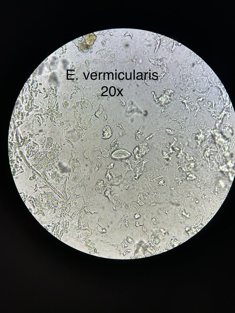 MicrobioHUPA's tweet photo. ☣️🪱🥚👶👧🏻👦🏼
Os mostramos huevos 🥚 de #Enterobius vermicularis🪱en un paciente de 5 años 👦🏽 con prurito anal e irritación
Muestra 🍑: Graham (ver técnica en imagen)
🔬20x: Huevo con larva en su interior
(Abrimos 🧵: oxiurasis por EV)
#parasitologia #microbiology https://t.co/ubGhq9iUnE