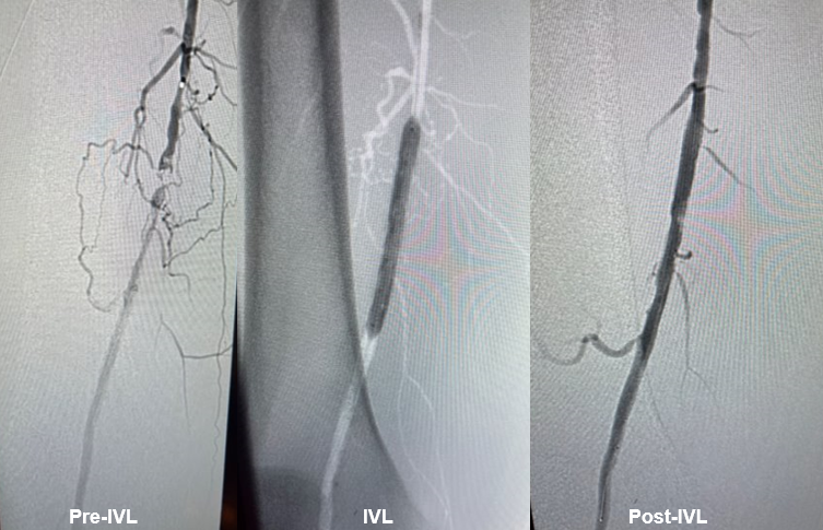 ShockwaveIVL's tweet photo. The pre & post images say it all! Dr Paul Foley, vascular surgeon at @DoylestownHlth, shocked the rock in an SFA calcified occlusion. He pre-dilated, used 6.0mm #ShockwaveM5Plus, finished with a 6.0 stent & post-dilated for a great result.
US Rx only. ISI https://t.co/sZ0NdzXNcV https://t.co/PumErVlNLD