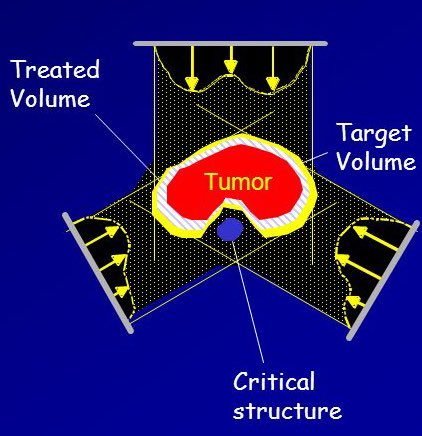 Thread | العلاج الاشعاعي ☢️ معروف ان من تقنيات العلاج الاشعاعي الخارجي بالفوتون تكون يا إما تقليدية '2DCRT' أو متقدمة '3DCRT , IMRT , Stereotaxy , IGRT , ART , PBT '. وموضوعنا اليوم حيكون عن : ✨3DCRT Versus IMRT✨