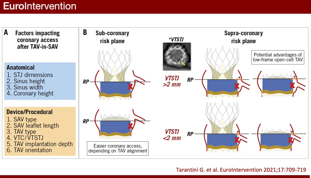 EuroInterventio's tweet photo. "Transcatheter aortic valve implantation in degenerated surgical aortic valves": a fully illustrated overview of the most significant periprocedural operative considerations for valve-in-valve TAVI by Tarantini et al. #EIJBestOf https://t.co/Jy8WTxr6qh https://t.co/vWkFswVDnQ
