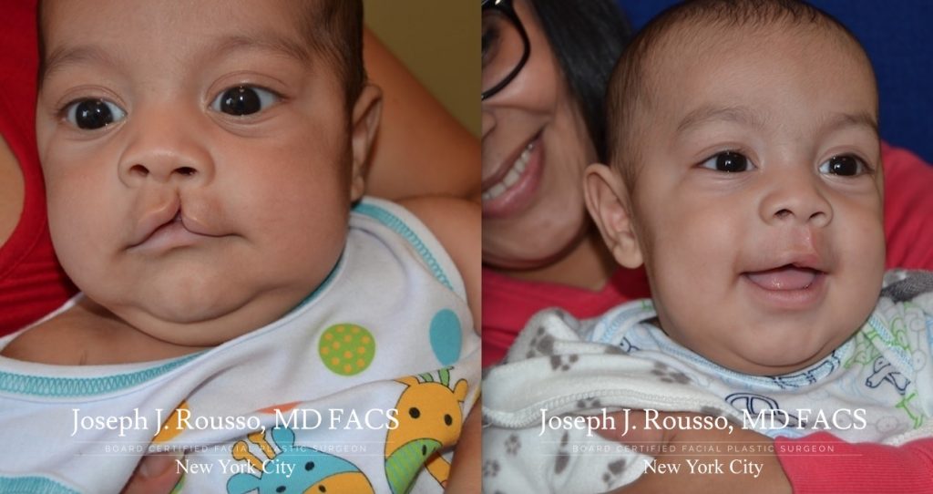 j_facs's tweet image. September is Craniofacial Acceptance Month. #DYK that there are over 17,000 known genes that contribute to craniofacial development and over 300 known syndromes with associated clefting? #NYC #FacialPlasticSurgery #CraniofacialAcceptanceMonth