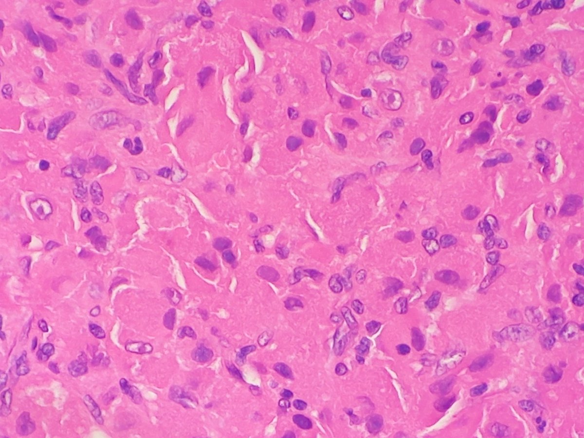 RibianszkyA's tweet photo. 30 yo F aryepiglottic fold biopsy. The tumor shows an agressive behavior.
S100 -, CD63 +!
Ddx?
Pitfalls? https://t.co/7PfmgTHk5E