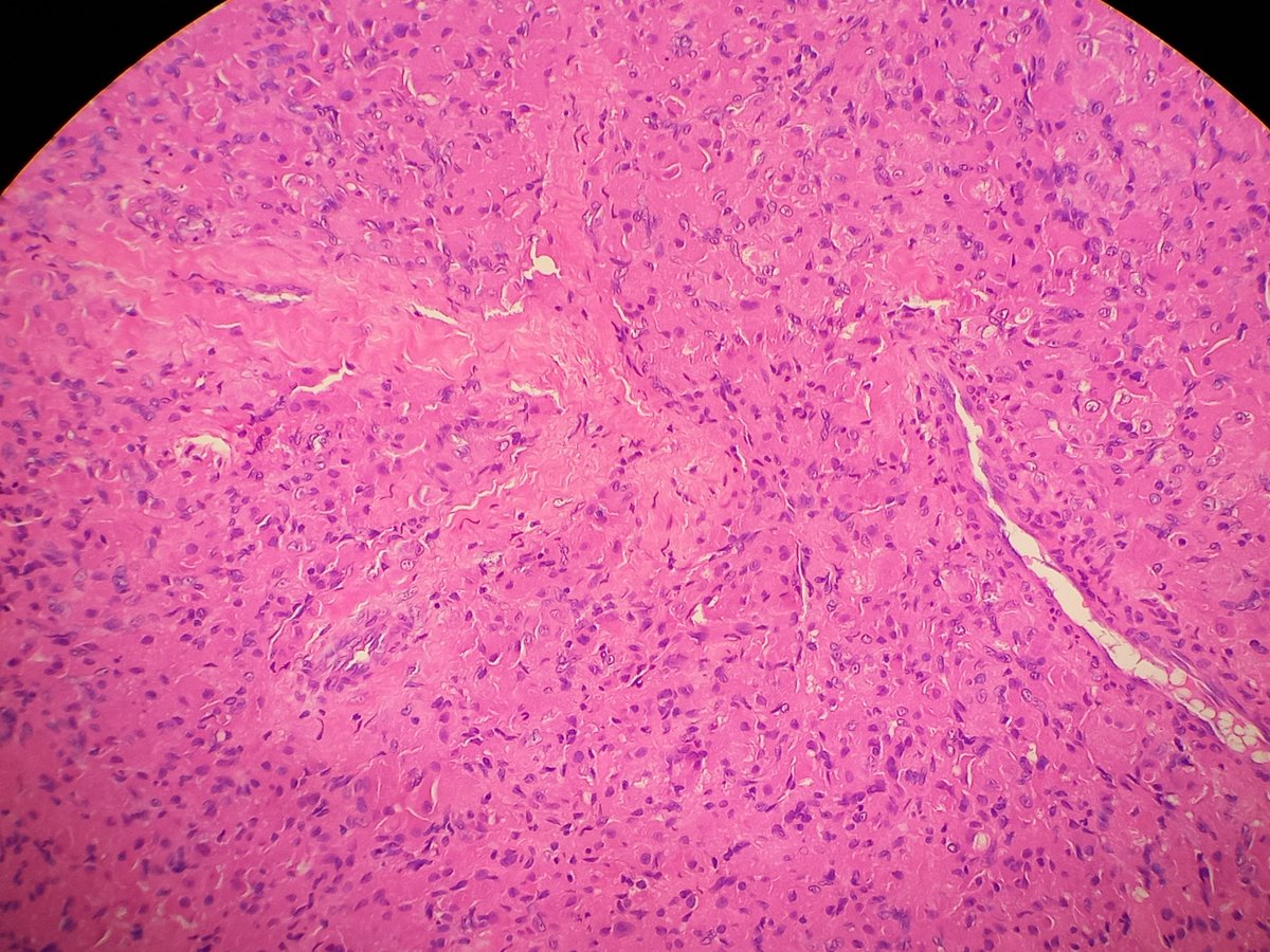 RibianszkyA's tweet photo. 30 yo F aryepiglottic fold biopsy. The tumor shows an agressive behavior.
S100 -, CD63 +!
Ddx?
Pitfalls? https://t.co/7PfmgTHk5E