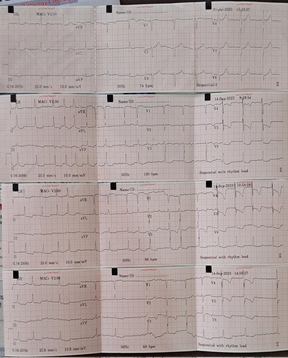 70F,on metoprolol, aspirin,atorva,torsemide+spiro, top ecg 1m old,rest ecgs done today,past echo dilated LA good LvSF.
Had 5-6epi of loose stool 2 day back, nw chestpain left side & dyspnea at rest, shock 80/60,no hypoxia,mild aki 1.55
Reason for shock?
Ecg analysis?
#MedTwitter