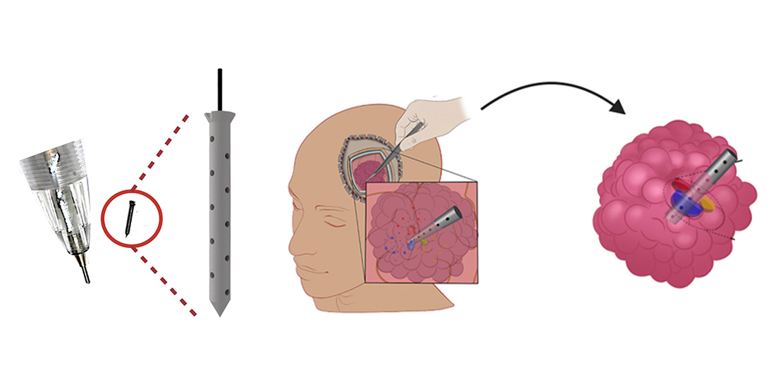 ONCOLife_HP's tweet image. A cutting-edge #microdevice, comparable in size to a grain of rice, promises a revolutionary approach to treating some forms of #BrainCancer. The trial demonstrated the device&apos;s ability to provide deep insights into drug effects on #gliomas. #Cancer healthandmedicine.net/microdevice-pe…