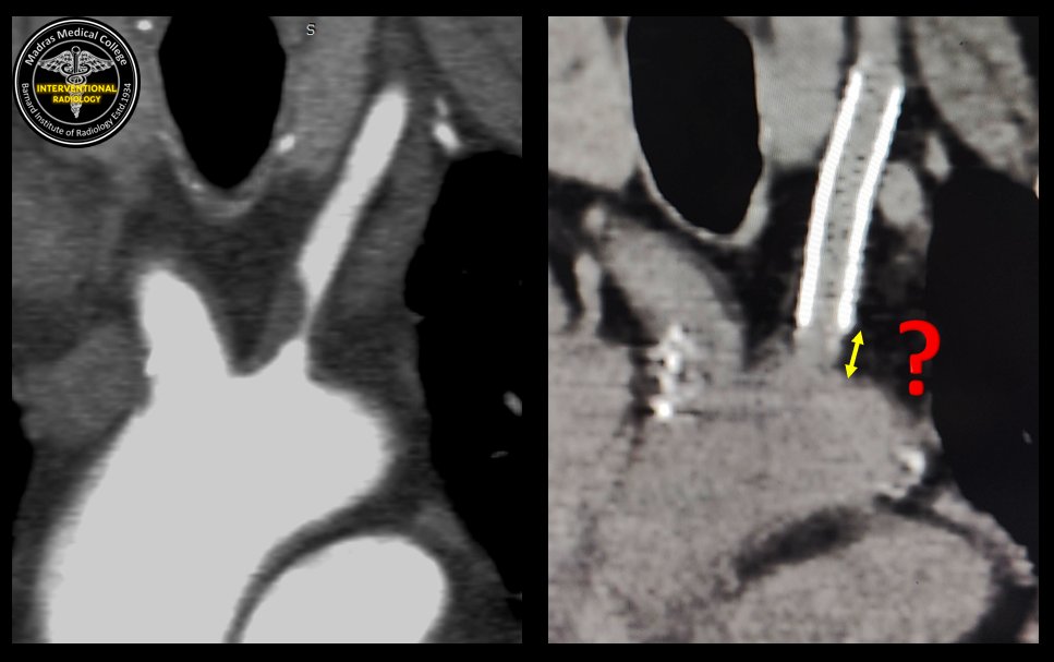 iRadBIR_Chennai's tweet photo. (2/2) What do you suggest? 
@DrNirmalyaRay @AshuPJadhav @Taka_Tamaso @CanadianNeuroIR @zafarhashim_INR @KalyanSajja @drgauravgangwni @GlobalEndovasc1 @SavithKumarINR @SharathKumarGG7 @drmanishy @BarathSitaram @Mjoshiindia @vimalchackomdy @RadJodhpur @eytanraz @GuenegoAdrien https://t.co/TjmWiKOcuI