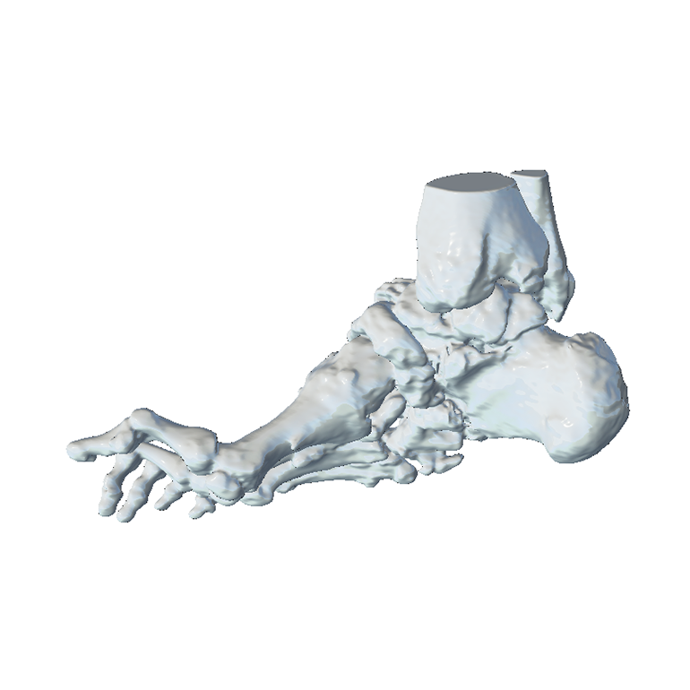 Correction of complex foot deformity using an external fixator. The anatomical model of the foot (CMD Class I) allows to plan the surgical approach, reducing intervention and recovery time.
<a href="/3d_maranon/">FabLab 3D Hospital Marañón</a> <a href="/rupermac/">Rubén Pérez-Mañanes, MD PhD</a> <a href="/calvoharo_ja/">José Antonio Calvo</a> #UPAM3D #HospitalGregorioMarañon #impresion3D