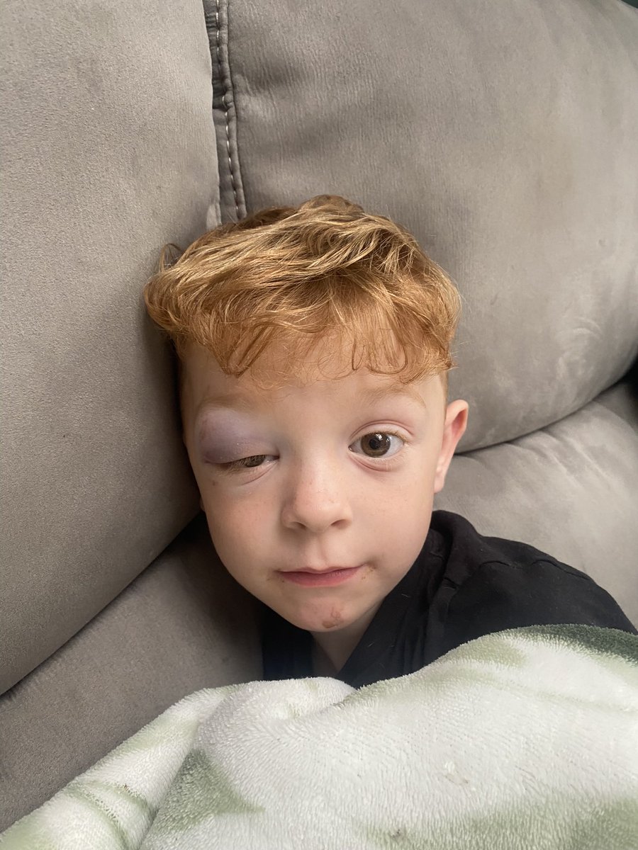 LorrenLedger's tweet photo. First rugby injury for my little man Finley! Clash of heads at training last night. Hoping to get some words of encouragement from his fave rugby player @ISA_Willie 😊 https://t.co/iJvylLFUmN