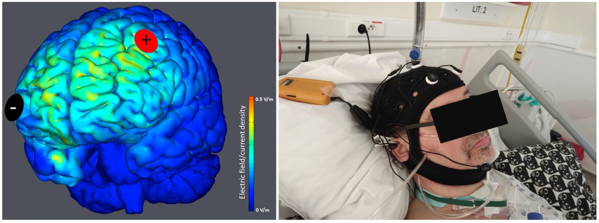 ULiège Research & Innovation (@uliegerecherche) on Twitter photo Study led by <a href="/Coma_Science/">Coma Science Group</a> <a href="/UniversiteLiege/">Université de Liège</a> has tested #tDCS on a large number of patients suffering from #consciousness #disorders following severe brain injury. A significant advance that will enable us to refine the therapeutic strategies to implement.
news.uliege.be/cms/c_18788781… Study led by <a href="/Coma_Science/">Coma Science Group</a> <a href="/UniversiteLiege/">Université de Liège</a> has tested #tDCS on a large number of patients suffering from #consciousness #disorders following severe brain injury. A significant advance that will enable us to refine the therapeutic strategies to implement.
news.uliege.be/cms/c_18788781…