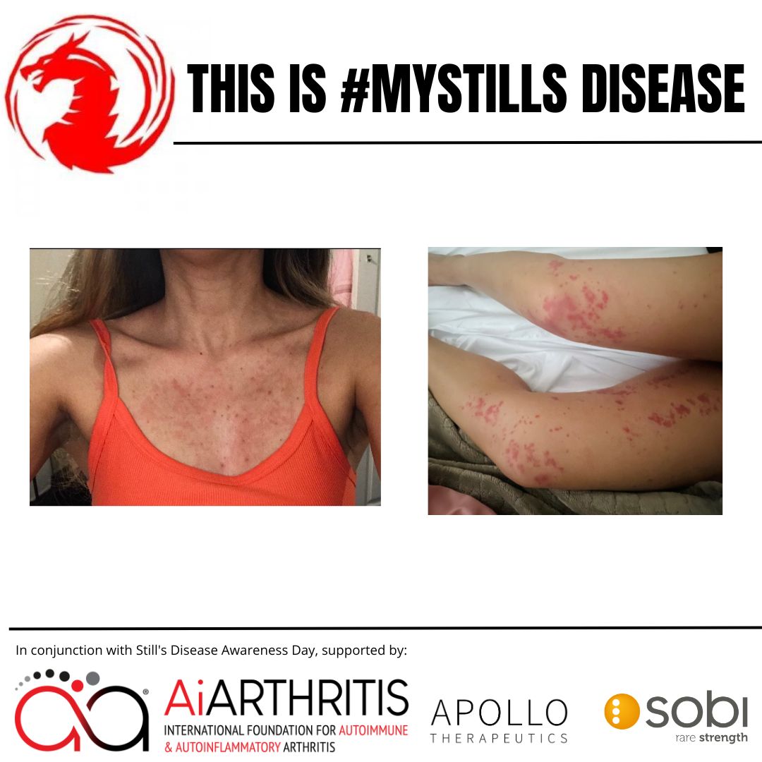 IFAiArthritis's tweet photo. Living with #Stillsdisease can be #physically and #emotionally challenging. It can cause intense #jointpain, f#evers, and #fatigue, affecting everyday life. Let's raise awareness for Stills Awareness Day and support those battling this# invisibleillness.Ā #MyStills #StillsDay https://t.co/QSorAY5G06