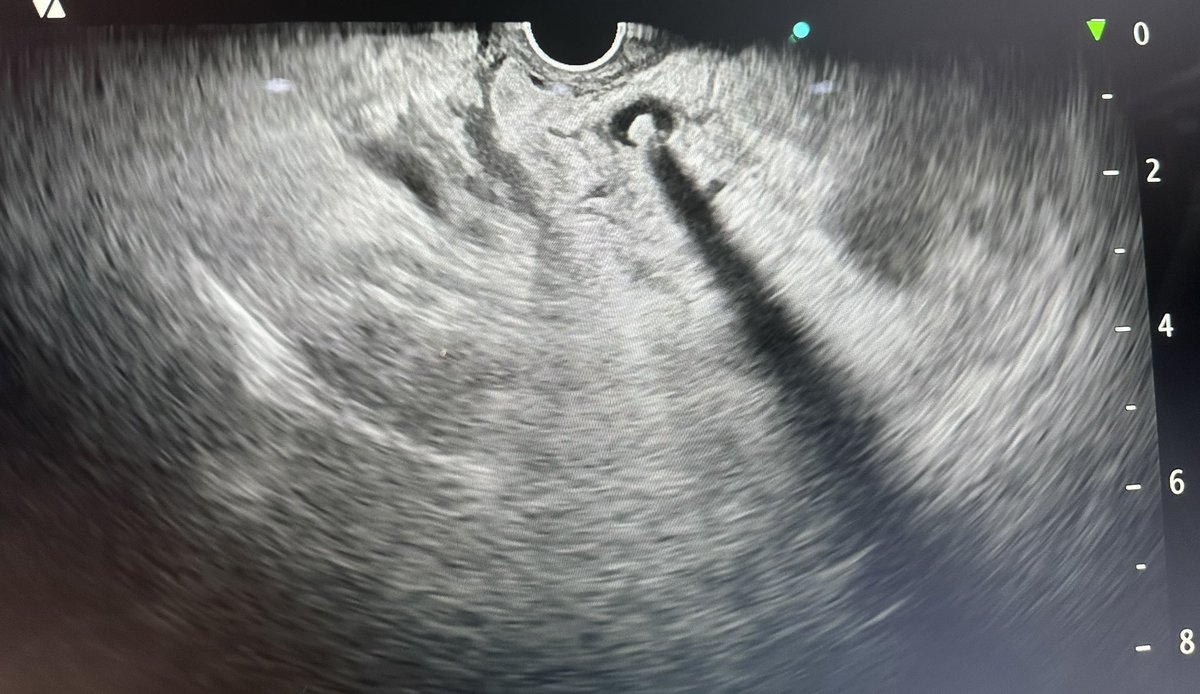 DrAnuragSachan's tweet photo. The beauty of EUS in finding small stones (4.4mm) with intermediate risk of choledocholithiasis… #EUS #Ercp @DharJahnvi @DrAnuraagJ @sachinhj @Dr_AntrikshKr @anupam_gastro 

https://t.co/pv8mrXE5Ne https://t.co/7syimsQLQC