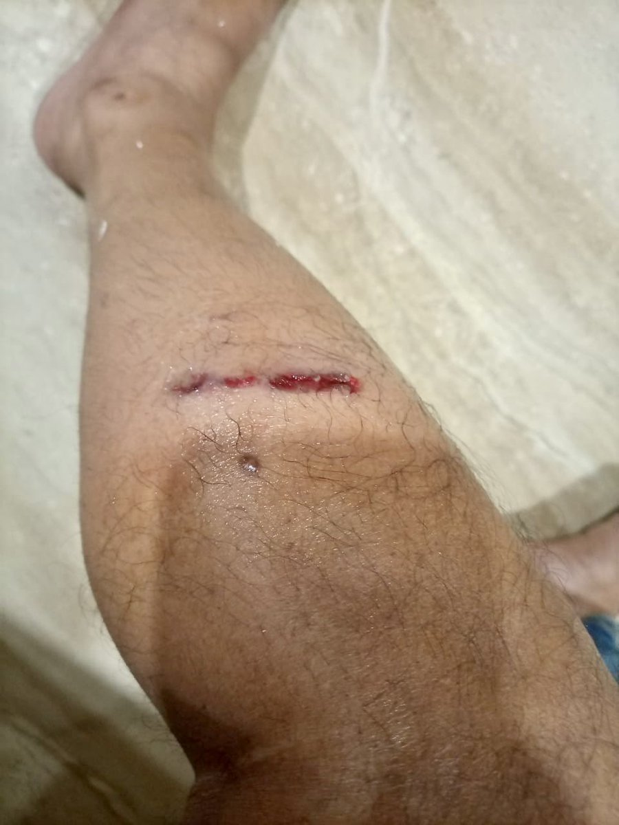 Sector 92, Noida. Almost every day someone gets bitten by strays. The two photos are of people I know. Some neighbours keep feeding them in residential spaces.
Complaint lodged with <a href="/noida_authority/">NOIDA Authority</a> a couple of months ago but nothing has been done. Hope <a href="/CeoNoida/">CEO, NOIDA Authority</a> acts on this.