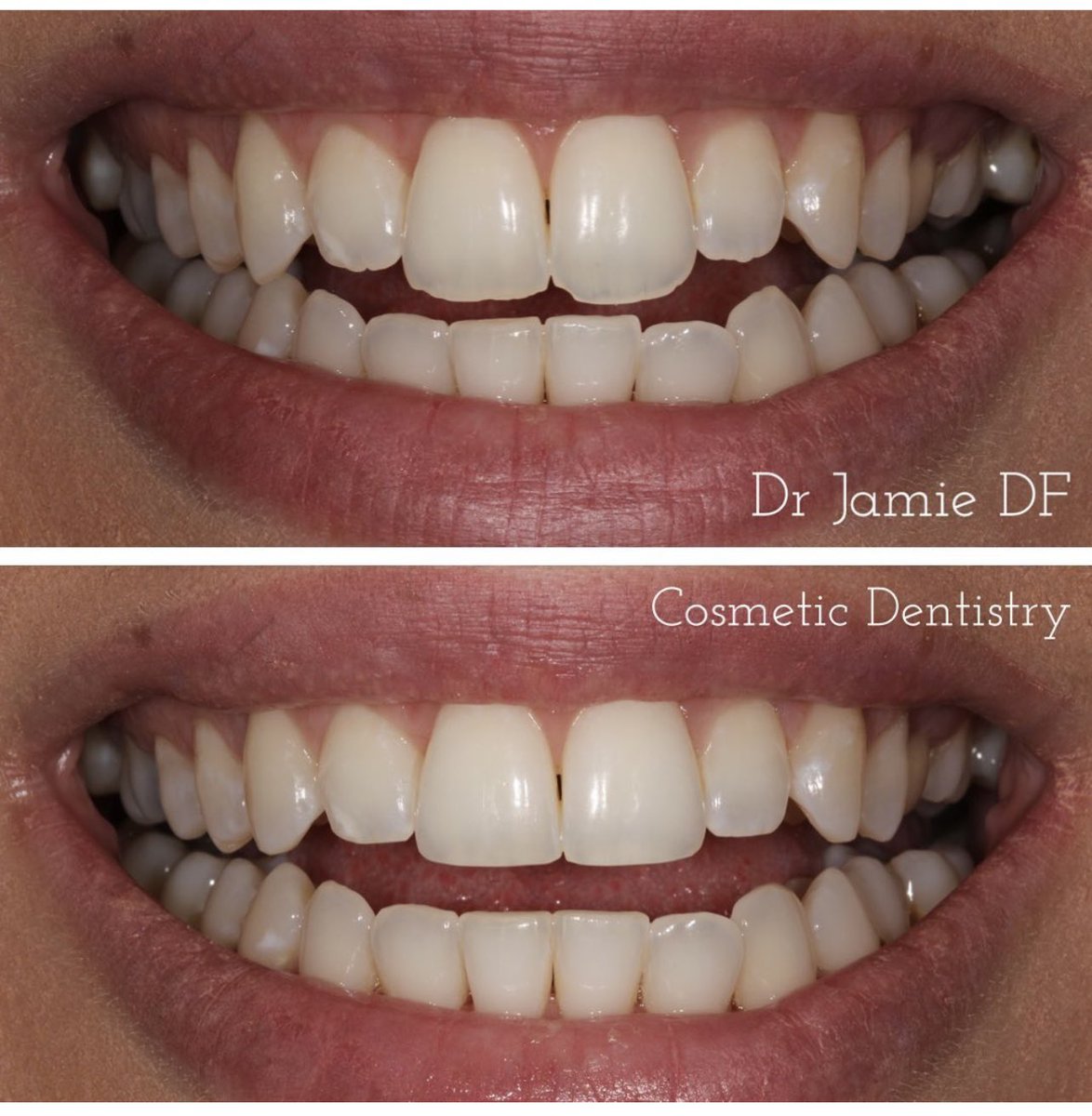 HarleyStSmile's tweet photo. Did you know that our most popular treatment gives the most dramatic results and is actually the cheapest? There is no drilling, no needles, no pain, no sensitivity, no downtime, no maintenance, &amp; takes about 30 minutes. WhatsApp or DM a photo to see your results (07340) 890034. https://t.co/PCkJdQqsoZ