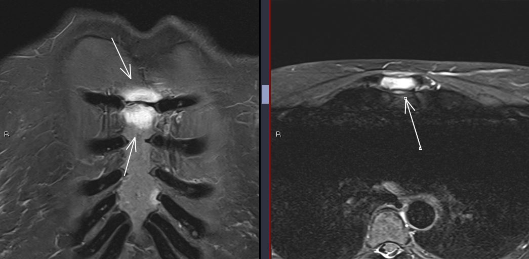 07/9/2023. Woman, sternum pain. MRI: manubriosternal arthropathy with bone marrow edema + 5th left costochondritis. Remember: inflammatory arthropathies (RA, PA, SAPHO syndrome...).🦴 #MSKRadiology #InflammatoryArthritis #TietzeSyndrome #rheumatology #costocondritis