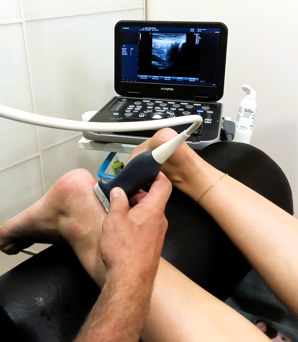 KiroFisio's tweet photo. Hoy acude a nuestra consulta un paciente con dolor en el Tendón de Aquiles. Gracias al ecógrafo podemos valorar el estado del tendón, descartar la existencia de calcificaciones y enfocar nuestro tratamiento. #valoracion #fisioterapia #ecografo #inflamaciontendinosa #trabajofisio https://t.co/wFY7xEIWRa