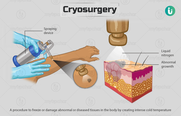 Cryosurgery is a type of surgery that involves the use of extreme cold to destroy abnormal tissues, such as tumors. The surgery most often involves the use of liquid nitrogen, although carbon dioxide and argon may also be used.
visit : longdom.org/cell-science-t…
#cellscience