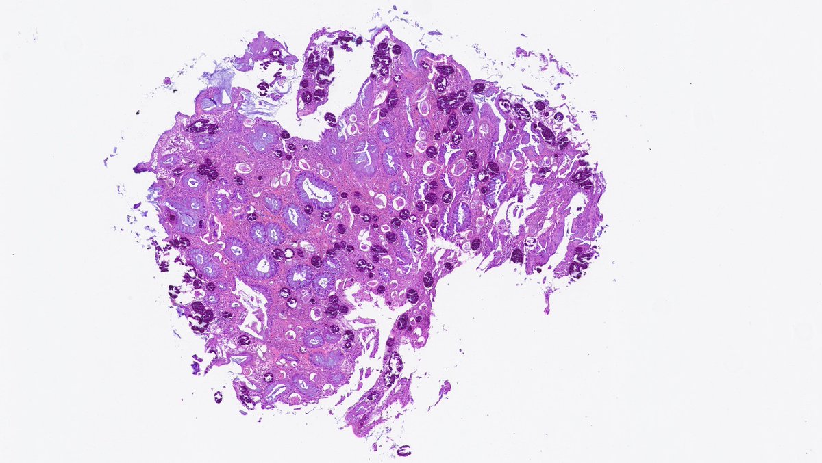 WillyFogPath's tweet image. Esquistosomiasis rectal👀:
🔸️Caso: ♂️ rectorragia. Colonoscopia➡️ pólipo rectal.
🔸️Agente: Schistosoma (🪱). 3 especies patológicas. 
🔸️Contagio contacto agua contaminada💧.
🔸️🔬:huevos🥚calcificados+ parásitos +eosinófilos.
🔸️Tto: 💊Praziquantel.
#GIPath #IDPath