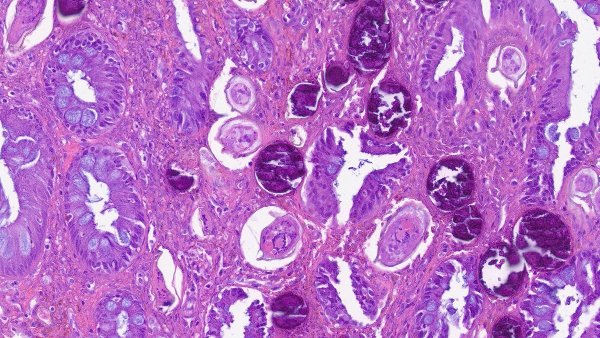 WillyFogPath's tweet image. Esquistosomiasis rectal👀:
🔸️Caso: ♂️ rectorragia. Colonoscopia➡️ pólipo rectal.
🔸️Agente: Schistosoma (🪱). 3 especies patológicas. 
🔸️Contagio contacto agua contaminada💧.
🔸️🔬:huevos🥚calcificados+ parásitos +eosinófilos.
🔸️Tto: 💊Praziquantel.
#GIPath #IDPath