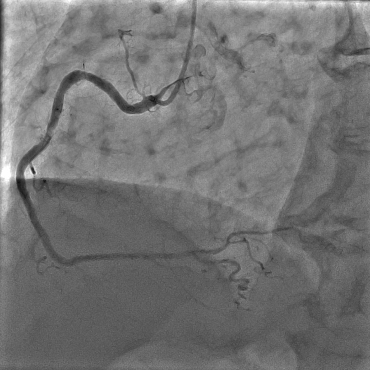 nicolasamabile's tweet photo. 74 y-o man with stable angina-previous PCI 18 months before (red arrow) and de novo mid RCA lesion (green arrow) https://t.co/fwWIPCmHPg